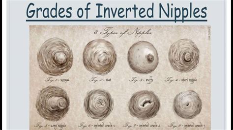 newly inverted nipple|Article: Newly Inverted Nipples: What Are the。